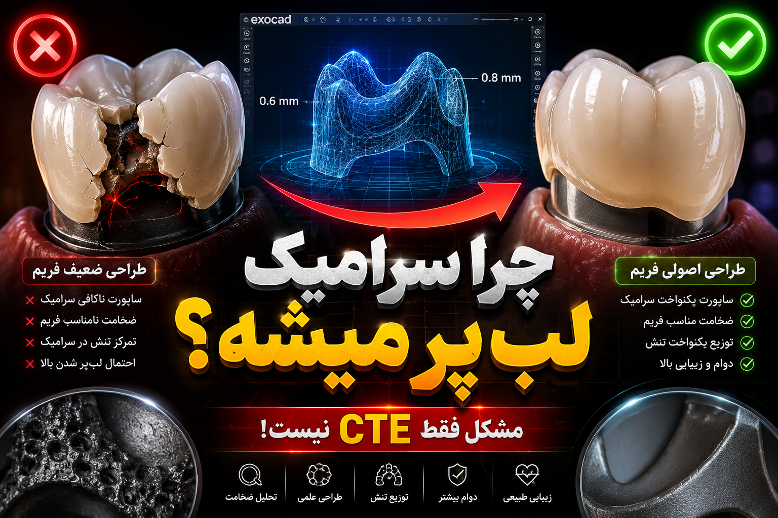 چرا سرامیک لب‌پر می‌شود؟ نقش طراحی فریم در موفقیت ترمیم‌های سرامیکی