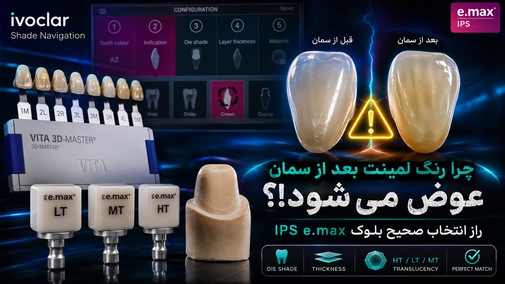 چرا رنگ لمینت بعد از سمان تغییر می‌کند؟ راهنمای انتخاب صحیح بلوک IPS e.max