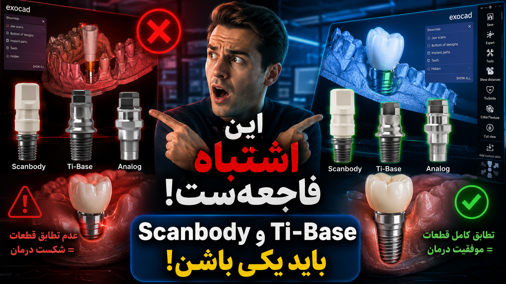 اهمیت تطابق Scanbody، Ti-Base و Analog در فلو دیجیتال ایمپلنت