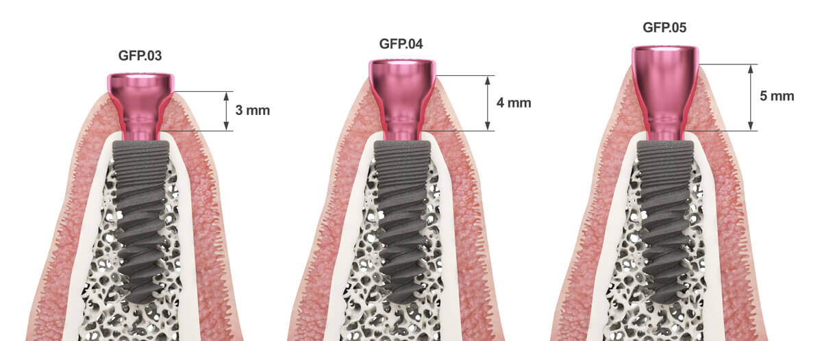 اثر پروفایل خروجیemergence profile و اندازه شکاف فضایی بر میزان سمان اضافی در بازسازی‌های کاشت ایمپلنت با سمان
