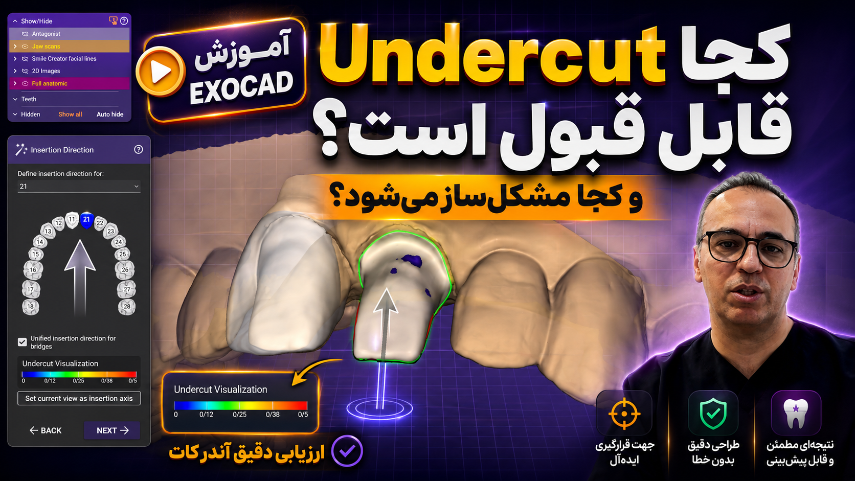 Undercut در EXOCAD؛ کجا قابل قبول است و کجا مشکل‌ساز می‌شود؟